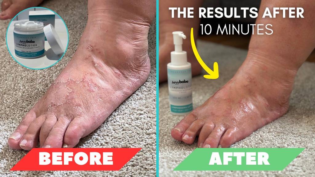 Non-Greasy Edema Lotion